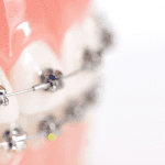 what to know before getting braces